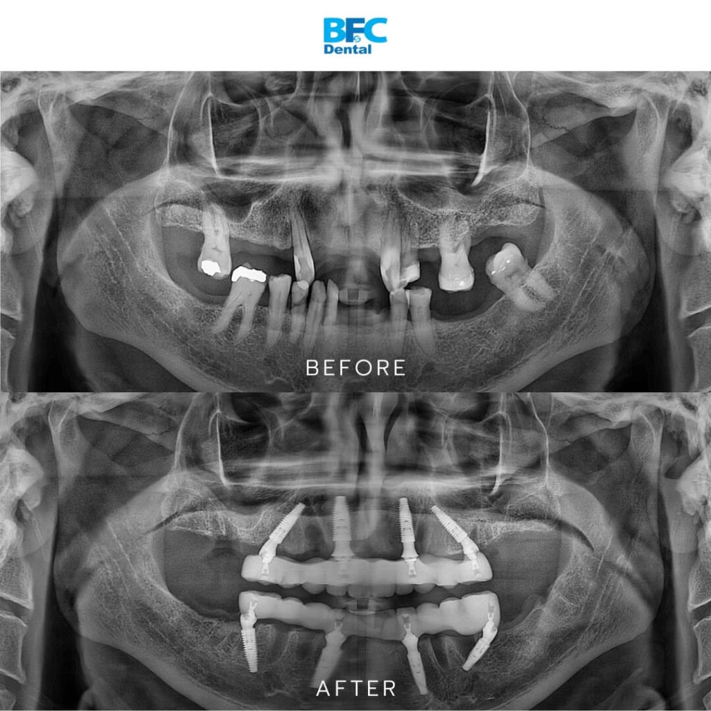 Full Mouth Dental Implants