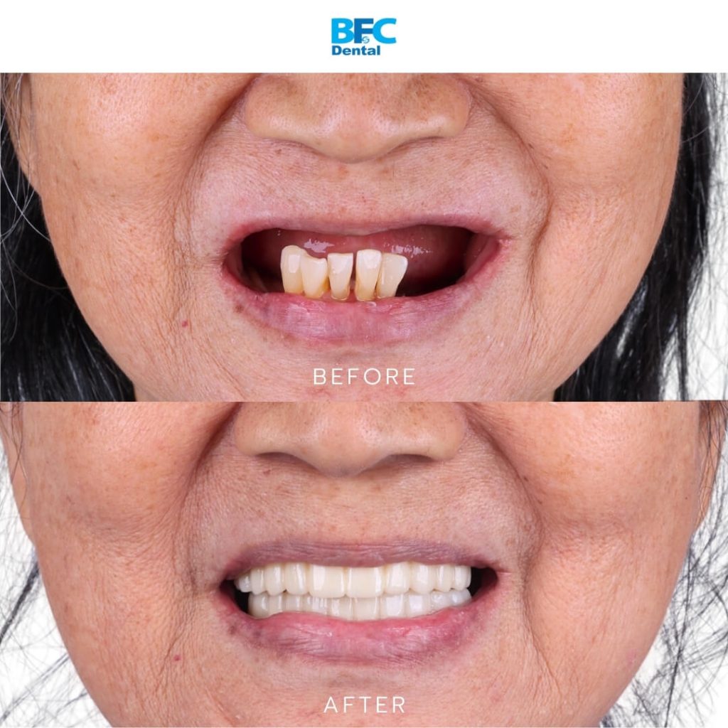 Full Mouth Dental Implants