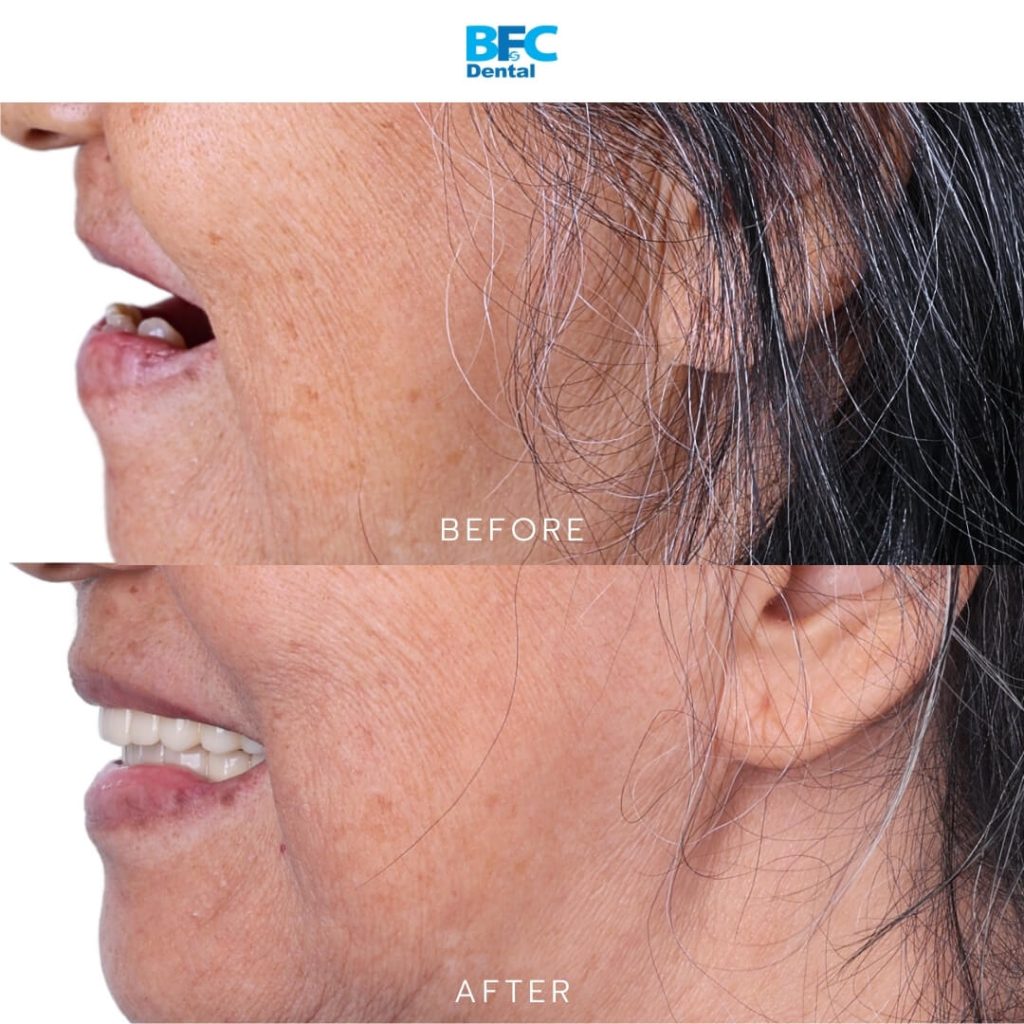 Full Mouth Dental Implants