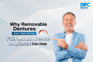 Full Mouth Dental Implants