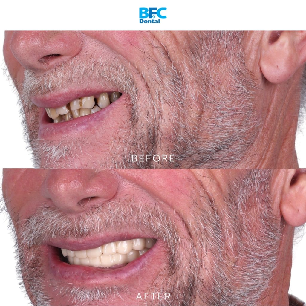 Full Mouth Dental Implants