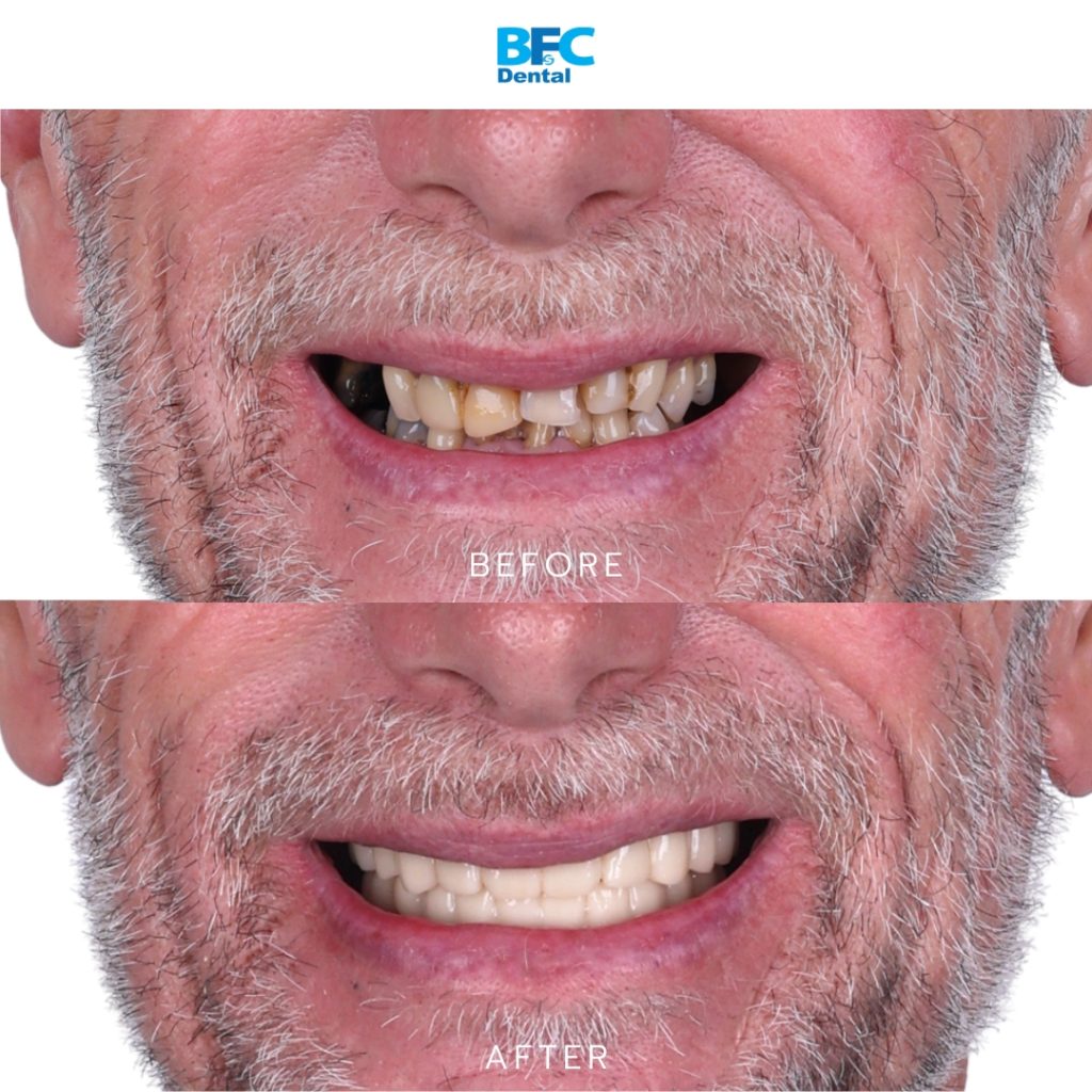 Full Mouth Dental Implants
