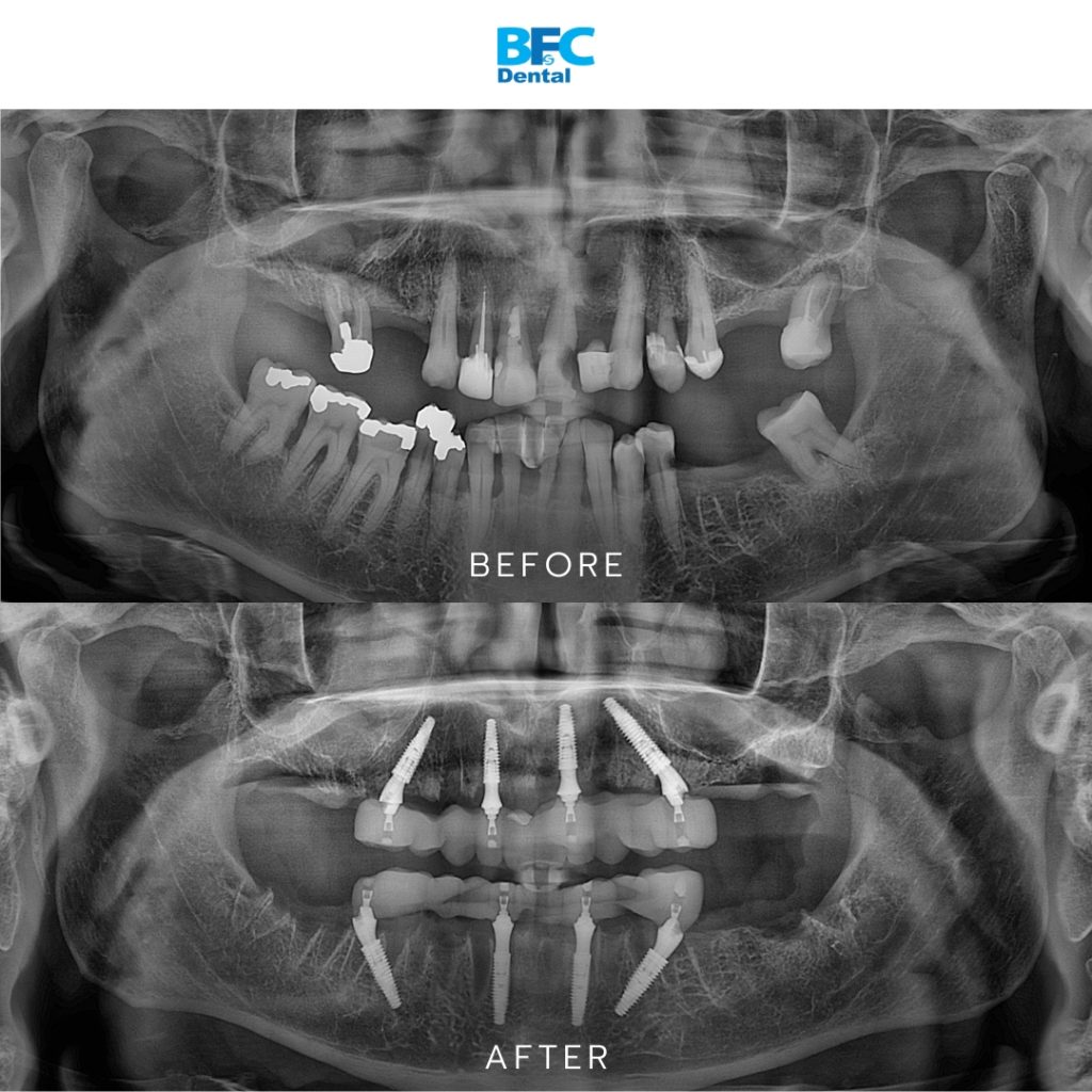 Full Mouth Dental Implants