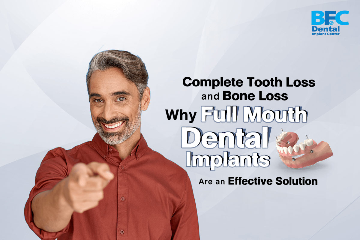 Full Mouth Dental Implants