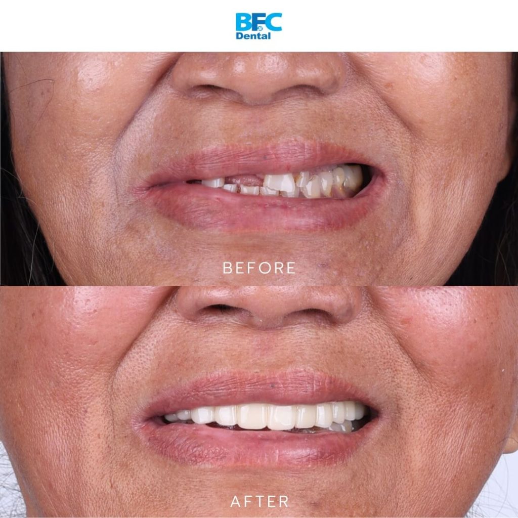 All-on-4 Dental Implants in Thailand