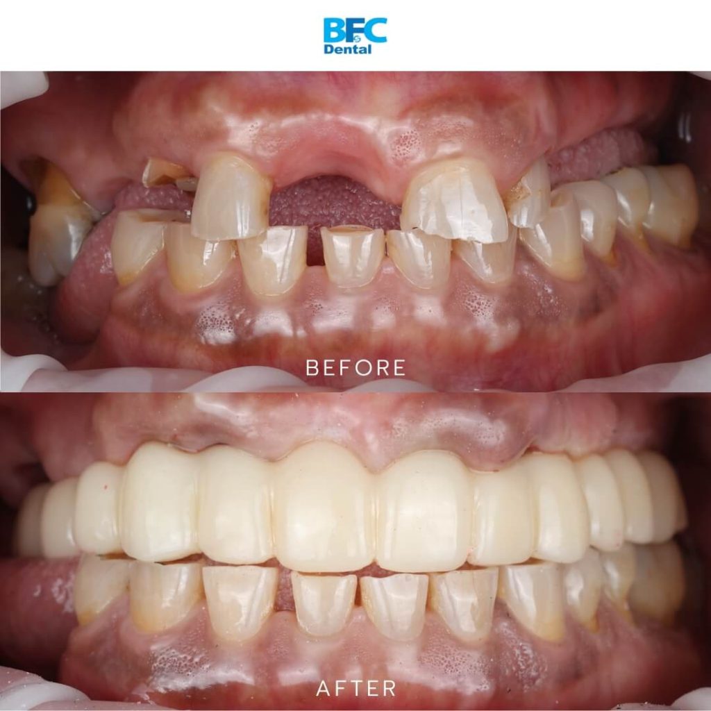 All-on-4 Dental Implants in Thailand
