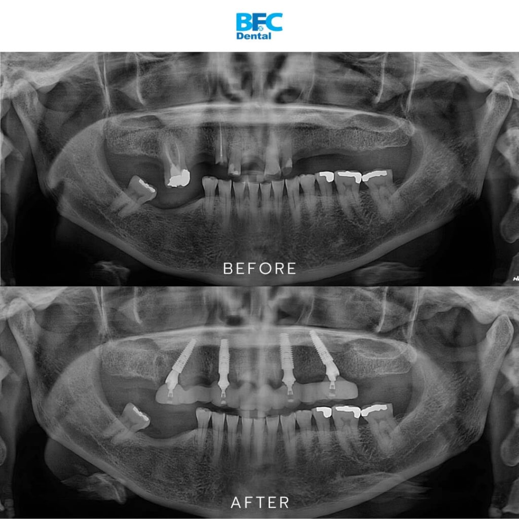 All-on-4 Dental Implants in Thailand