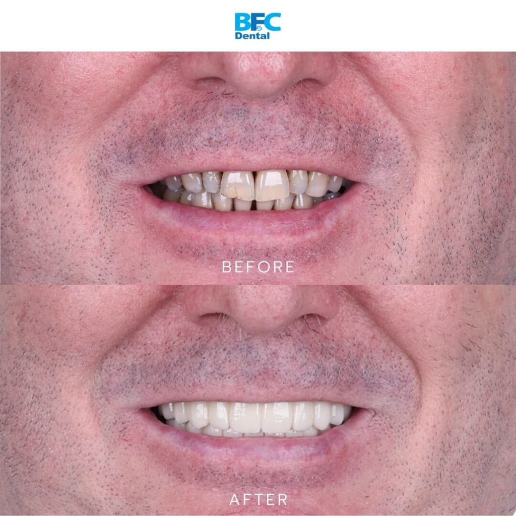 All-on-4 Implants