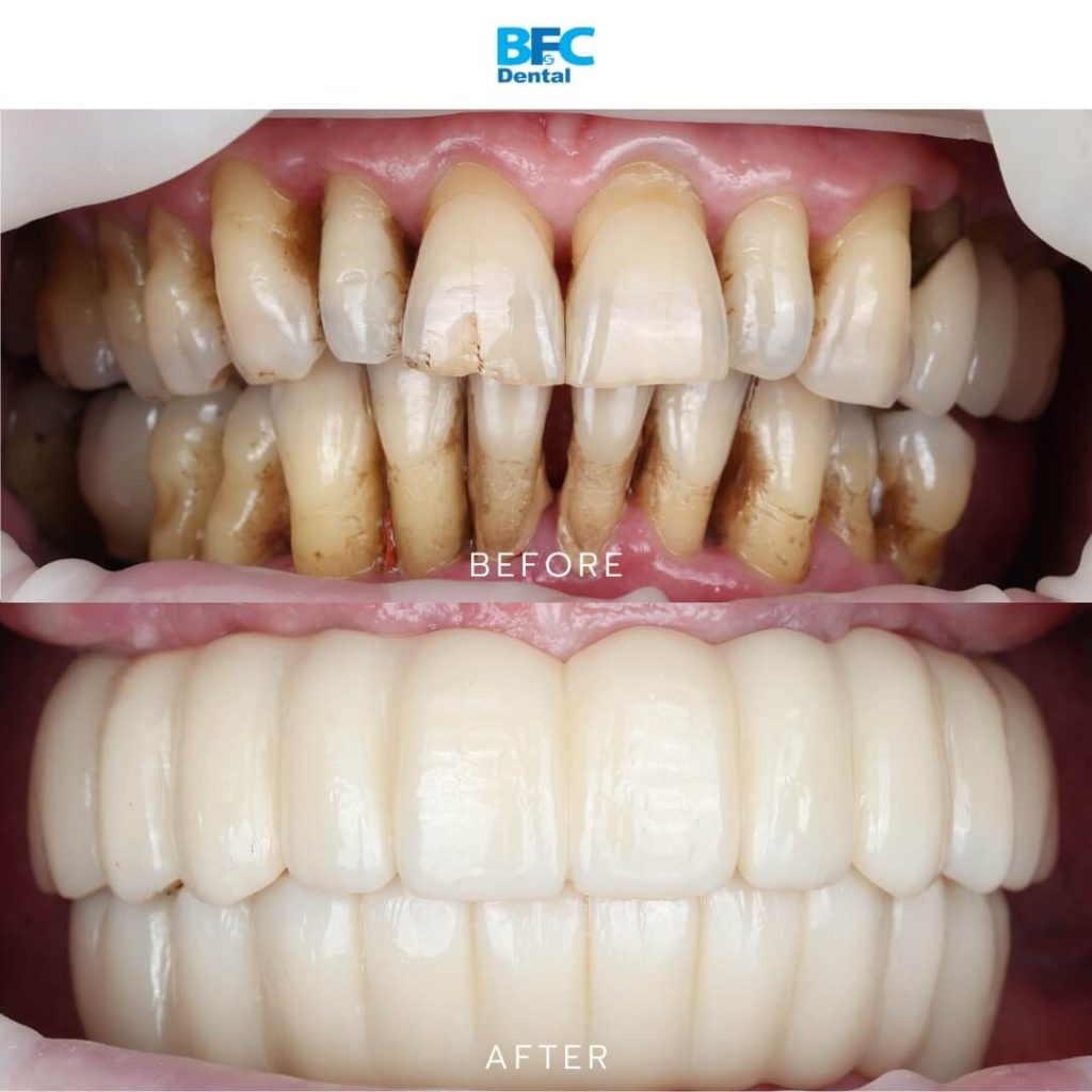All-on-4 Implants
