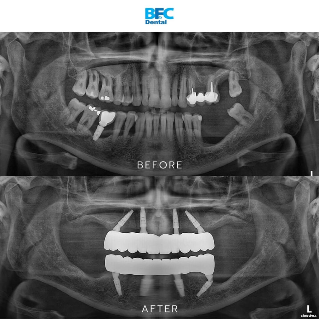 All-on-4 Implants