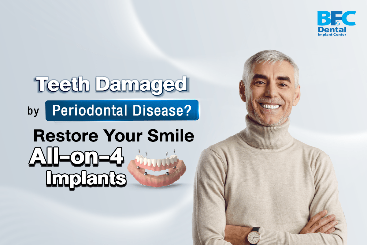 All-on-4 Implants