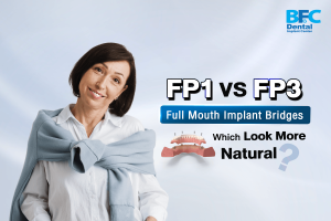 Full Mouth Implant Bridges
