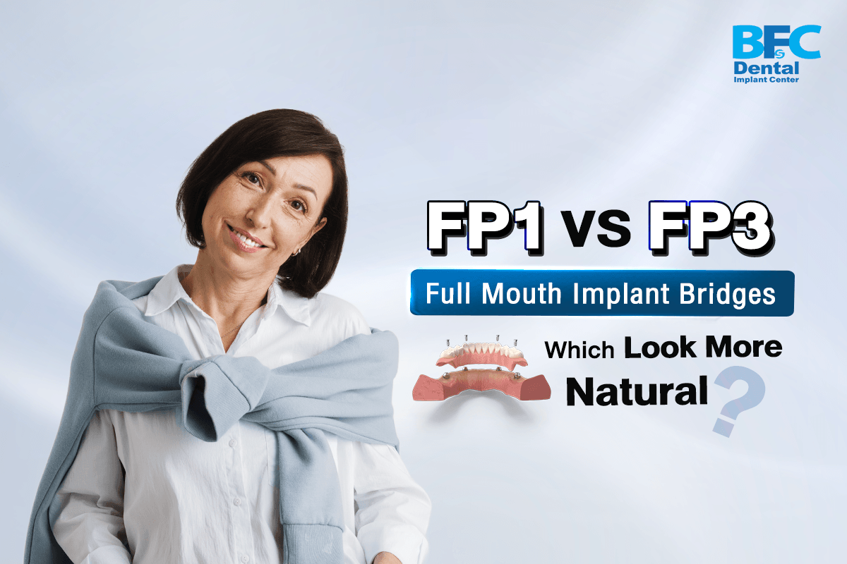 Full Mouth Implant Bridges