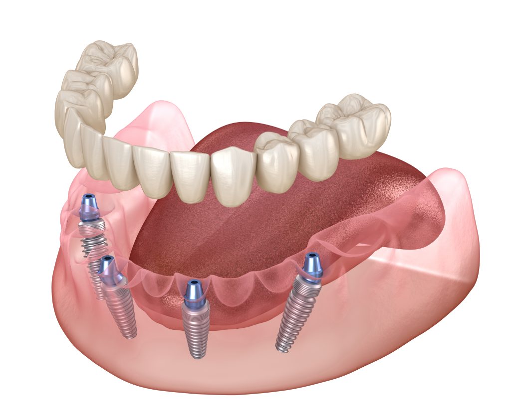 Full Mouth Implant Bridges