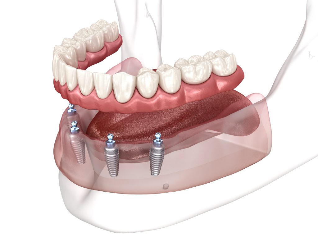 Full Mouth Implant Bridges