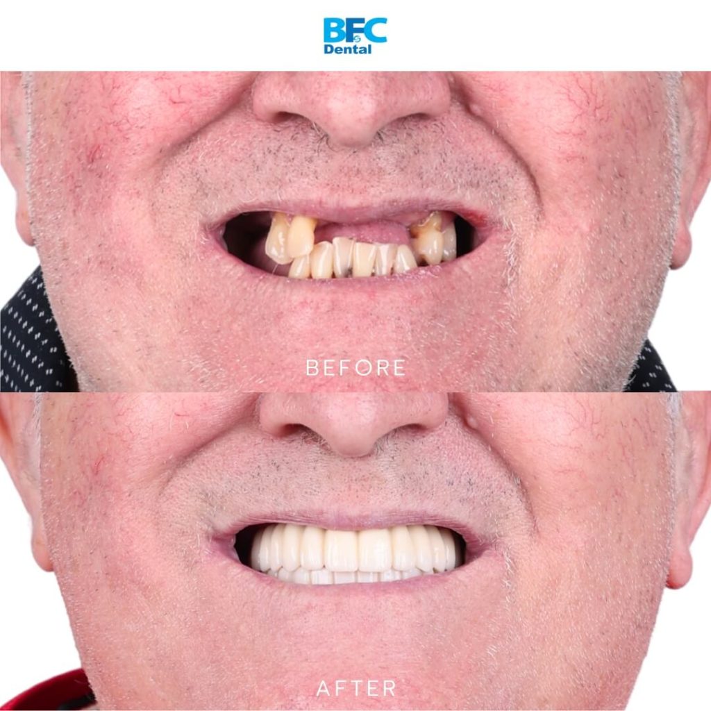 All-on-4 Implants