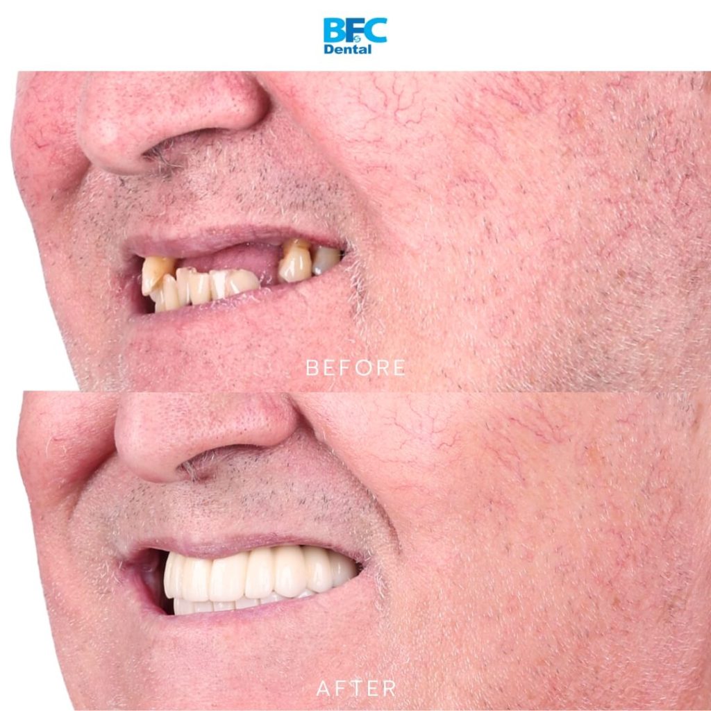 All-on-4 Implants