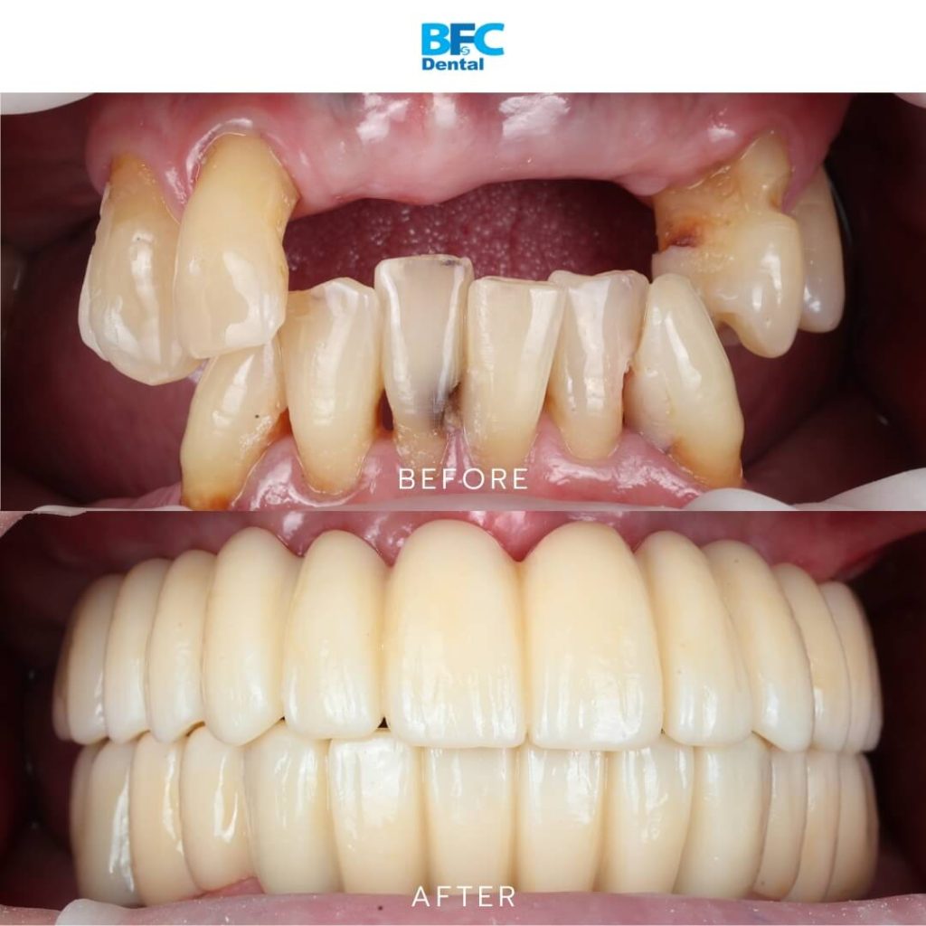 All-on-4 Implants