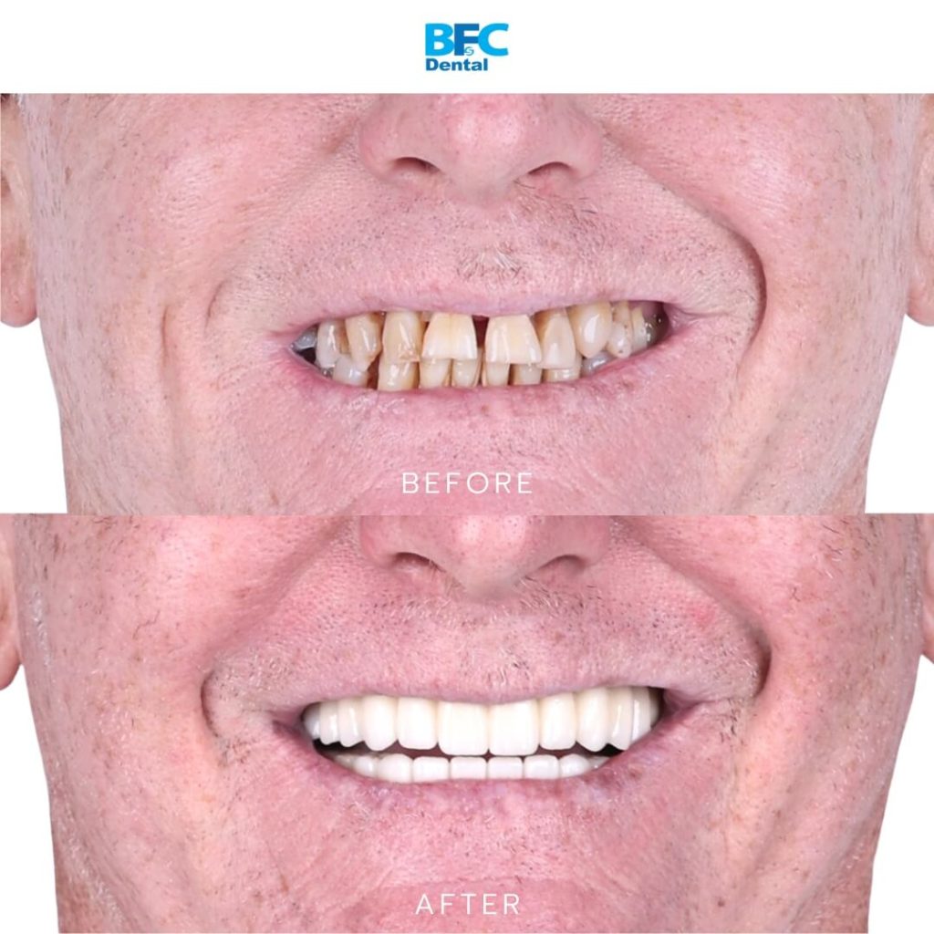 All-on-4 Full Mouth Implant
