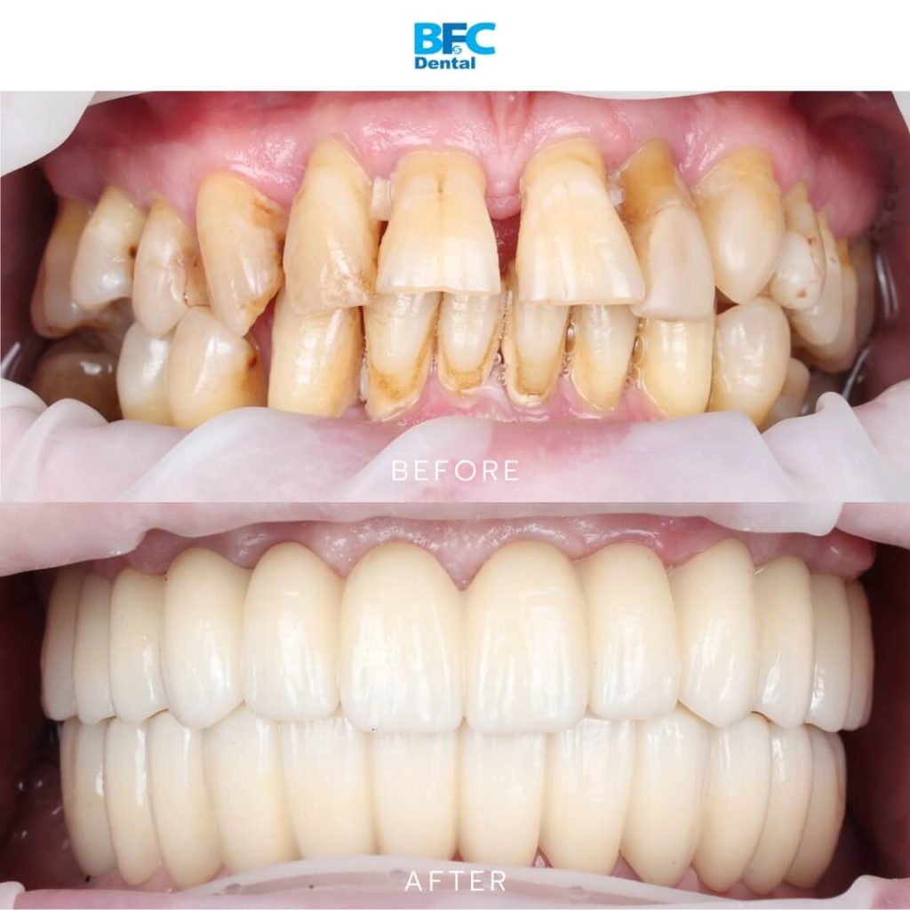 All-on-4 Full Mouth Implant