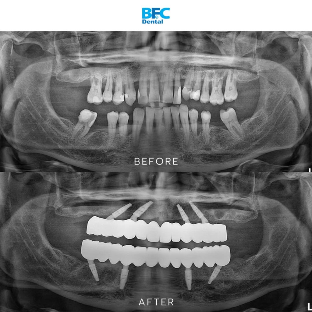 All-on-4 Full Mouth Implant