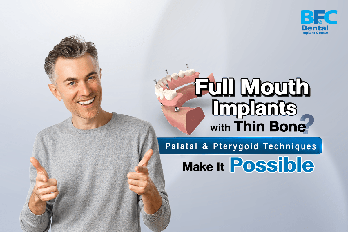 Palatal & Pterygoid Implants