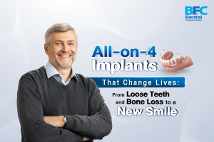 All-on-4 Implants