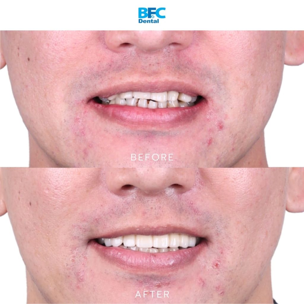 Palatal & Pterygoid Implants