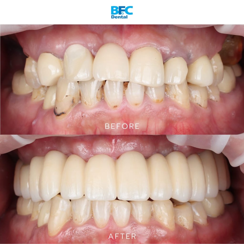 Palatal & Pterygoid Implants