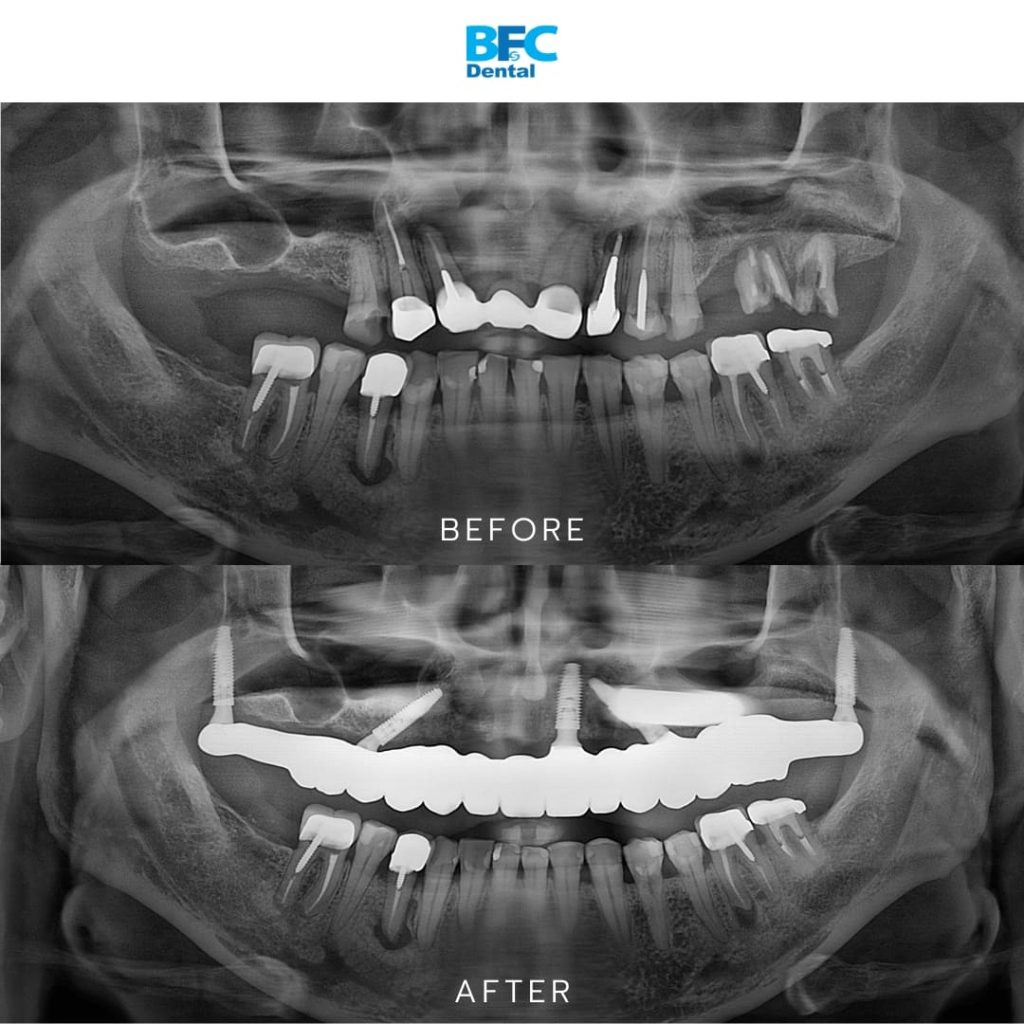 Palatal & Pterygoid Implants