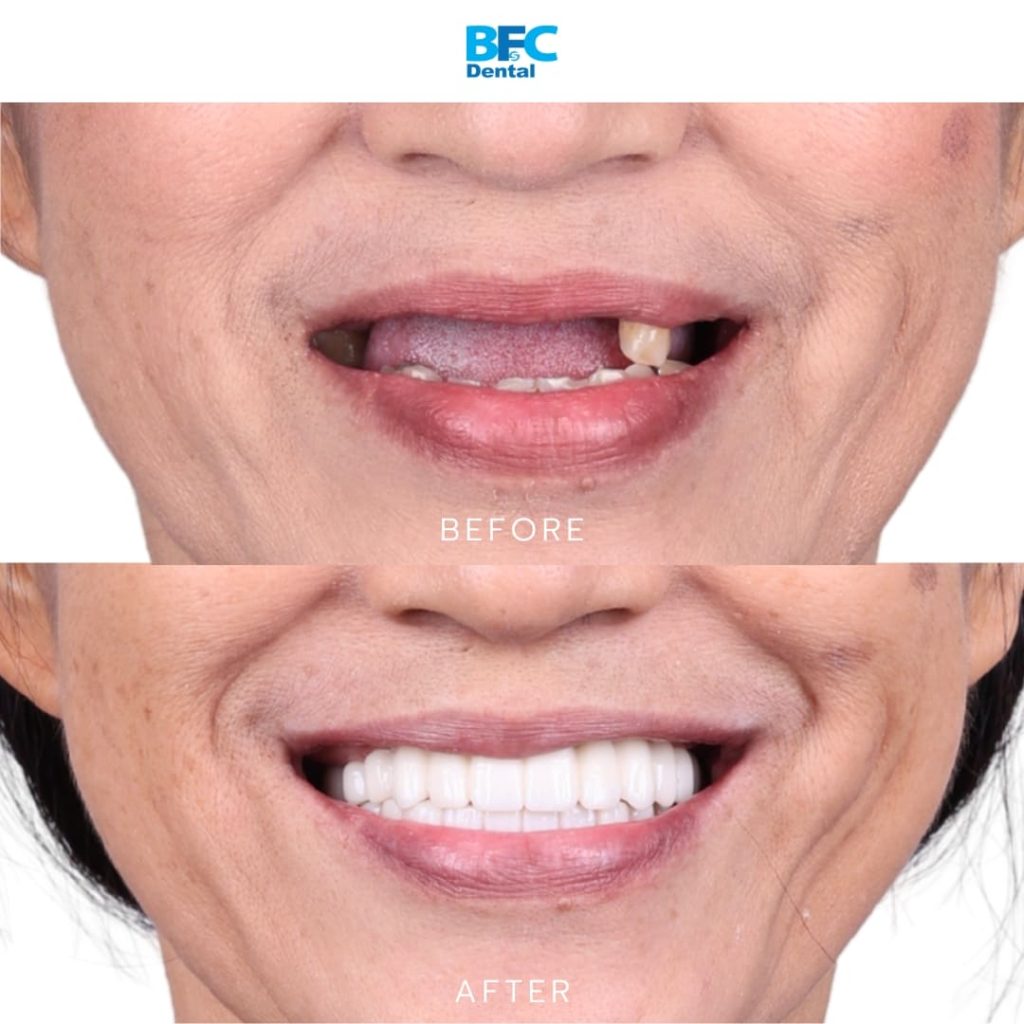 Palatal Approach Implants
