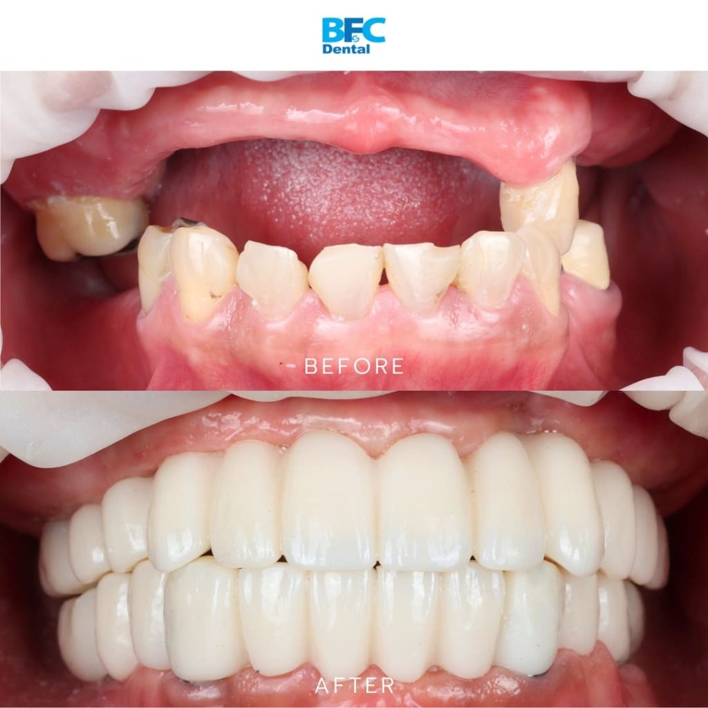 Palatal Approach Implants