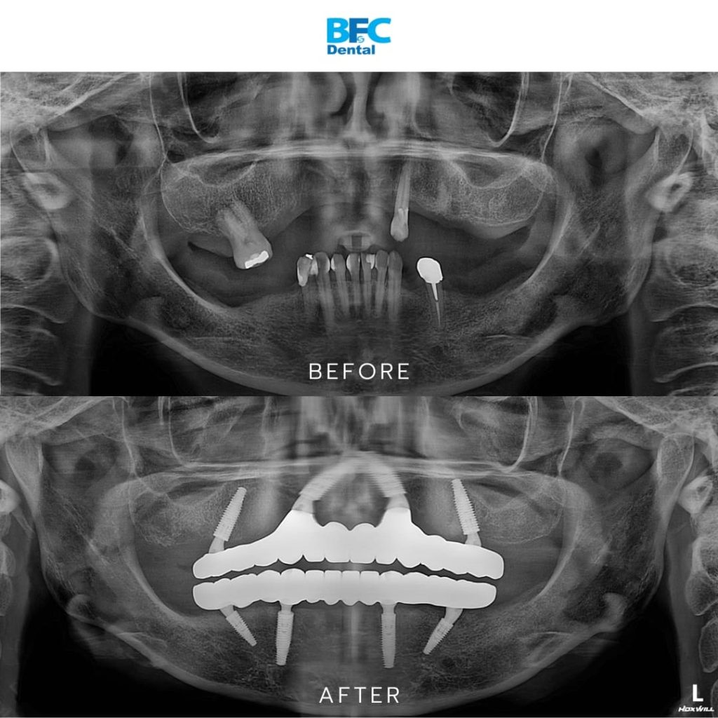 Palatal Approach Implants
