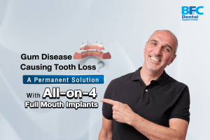 All-on-4 Full Mouth Implants