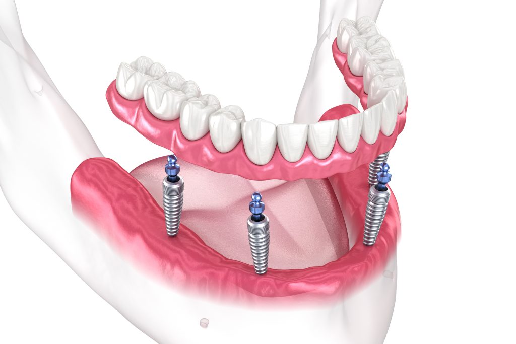 Full Mouth Dental Implants