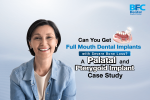 Palatal and Pterygoid Implant