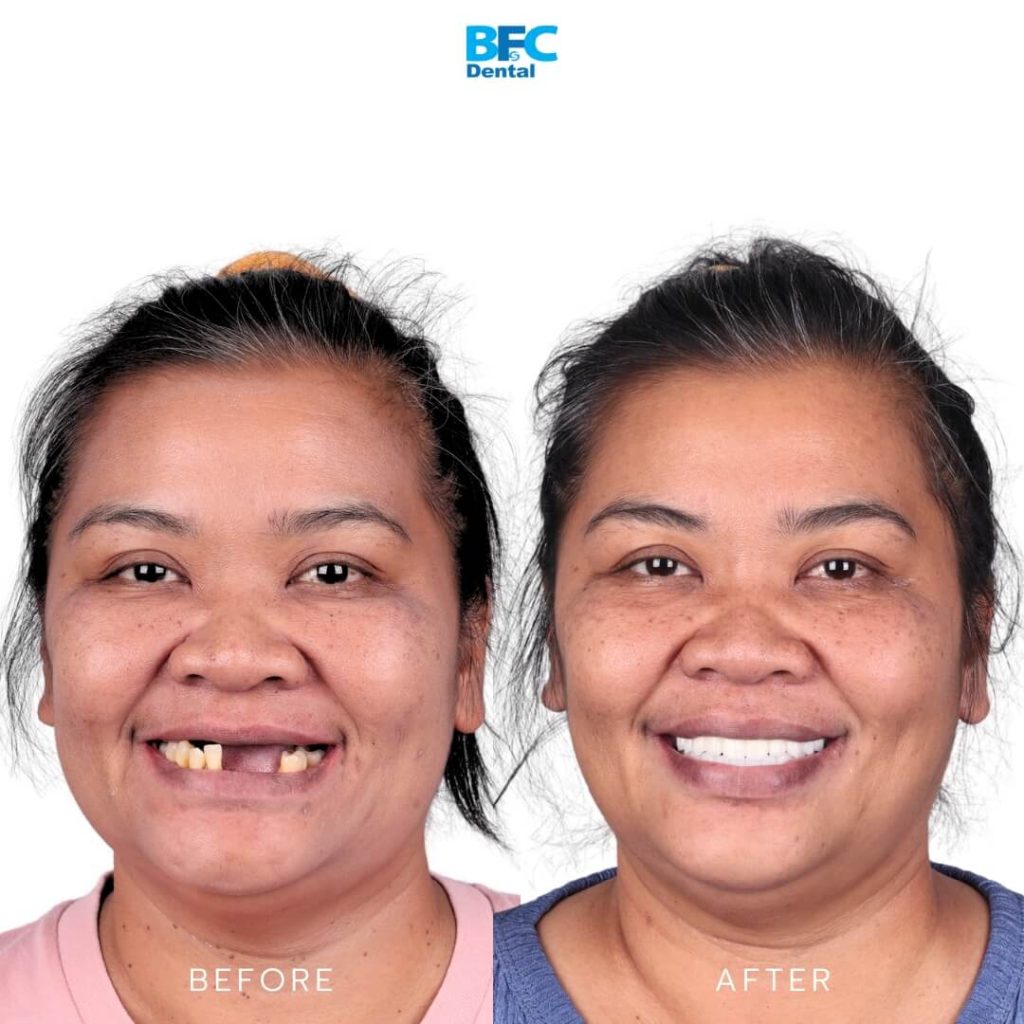 Palatal and Pterygoid Implant