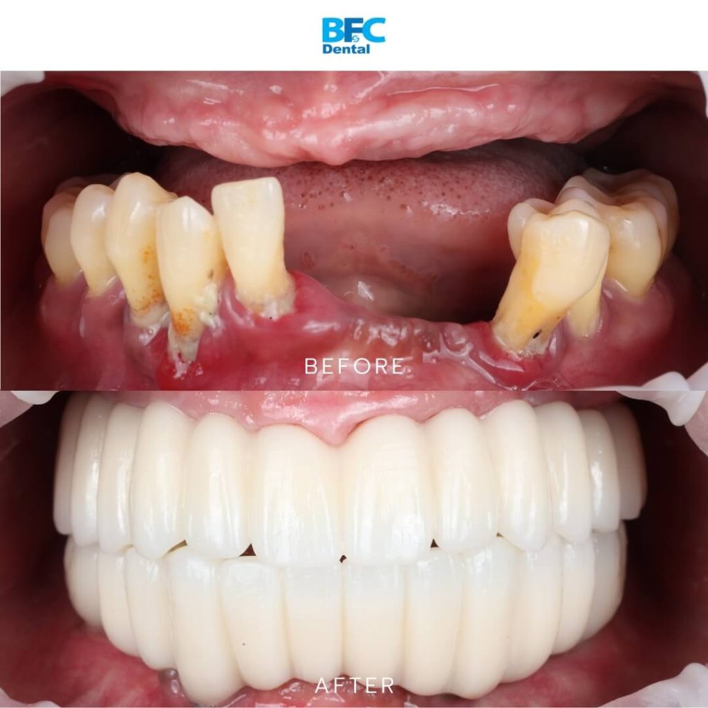 Palatal and Pterygoid Implant