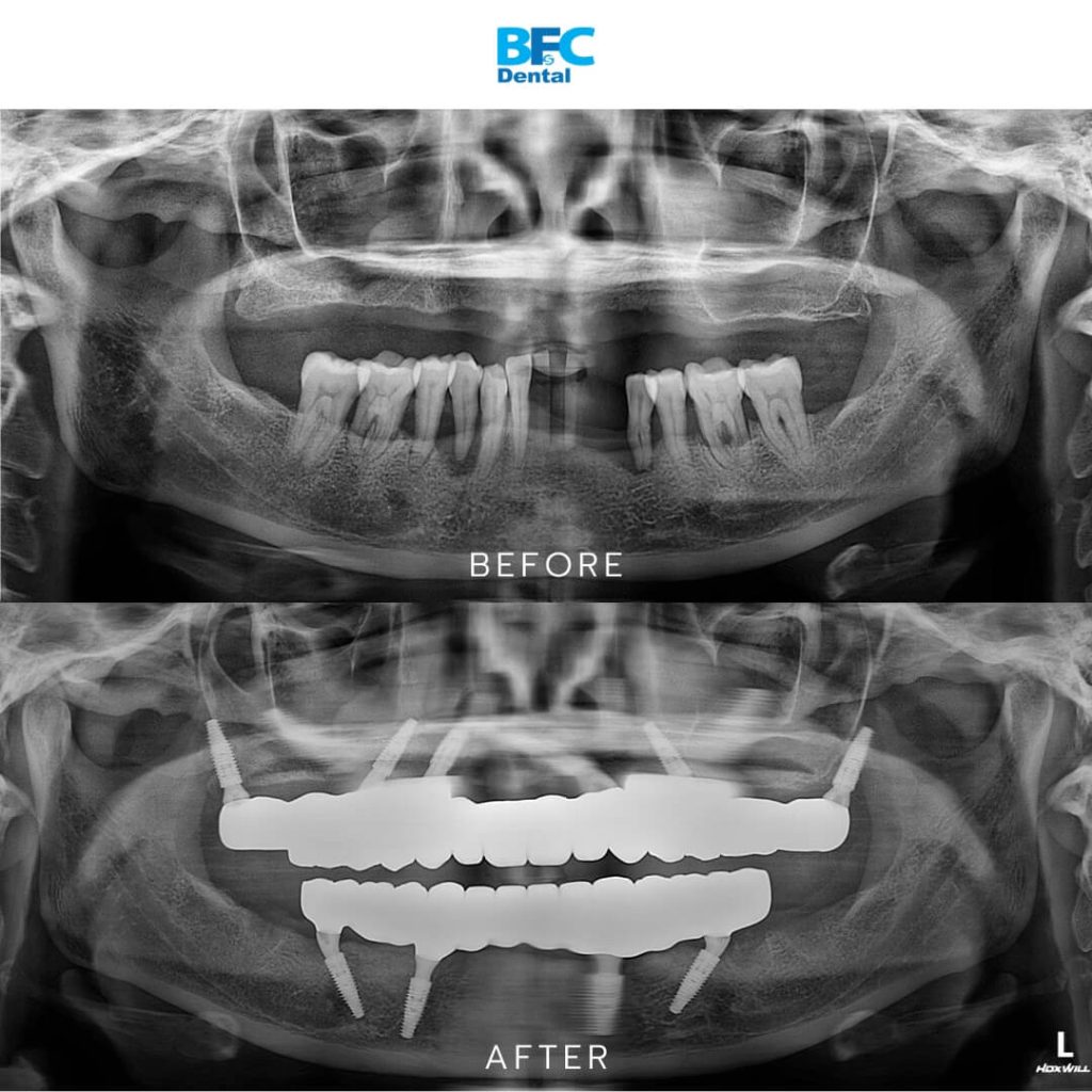 Palatal and Pterygoid Implant