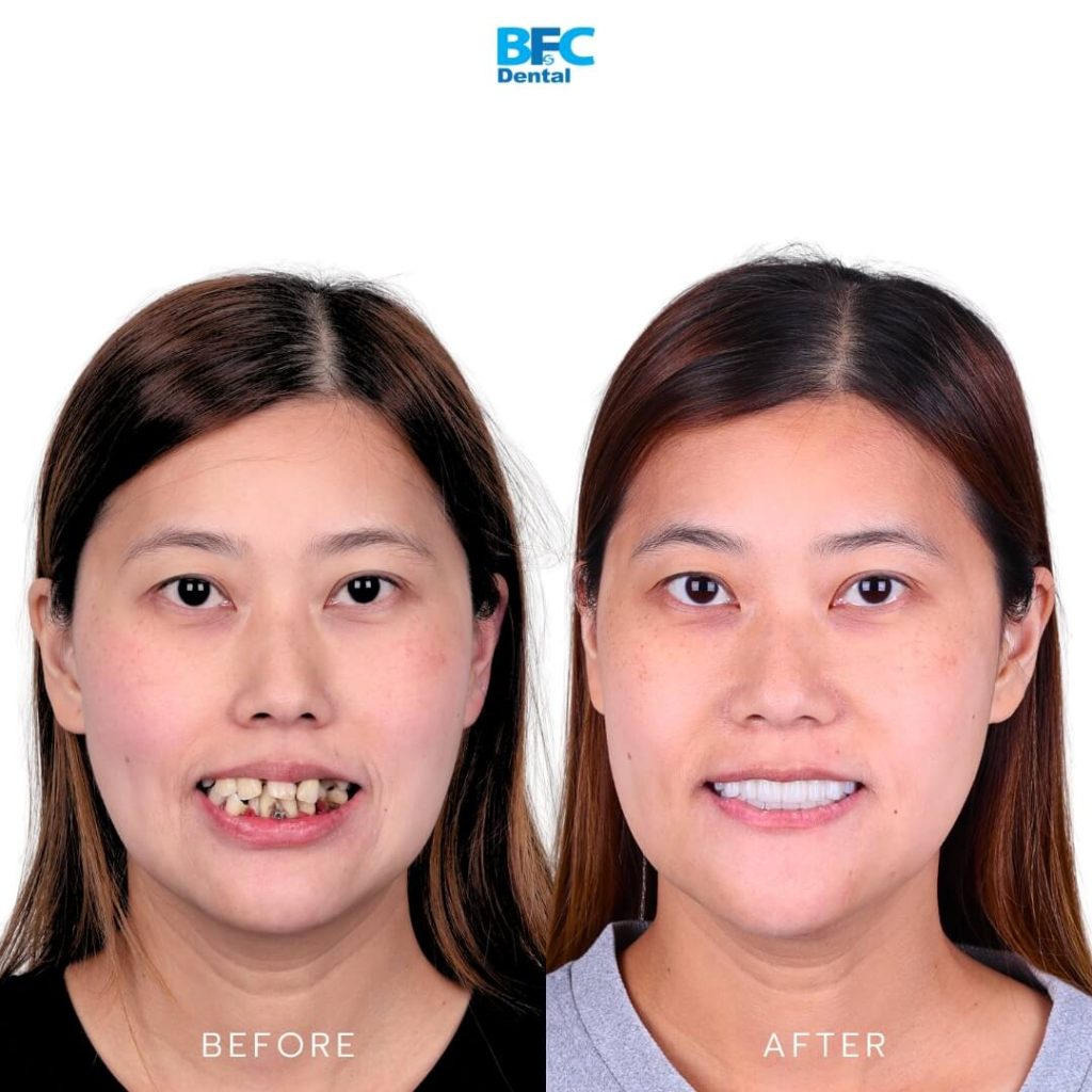 Pterygoid and Palatal Techniques