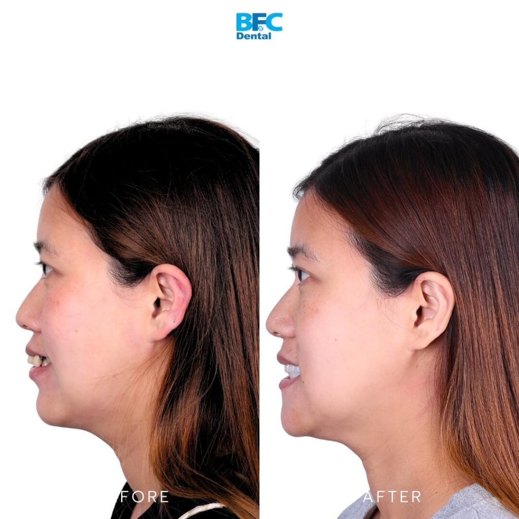 Pterygoid and Palatal Techniques