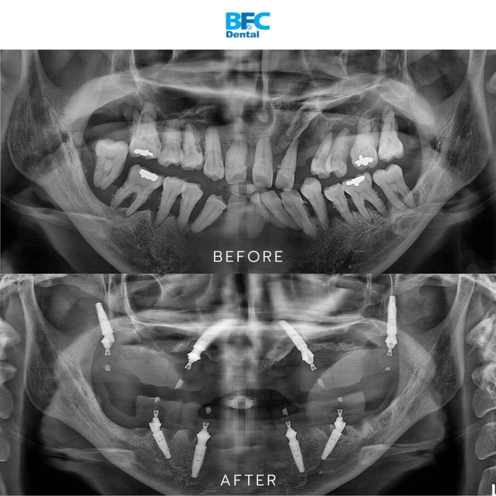 Pterygoid and Palatal Techniques