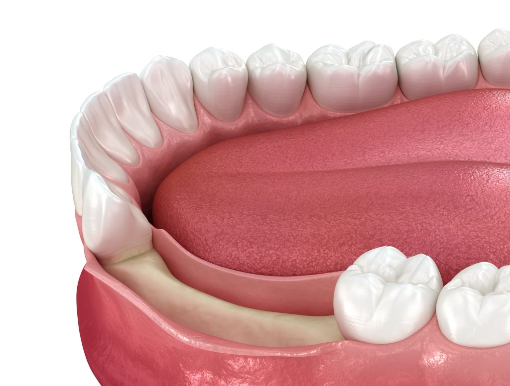 Pterygoid & Palatal Implants