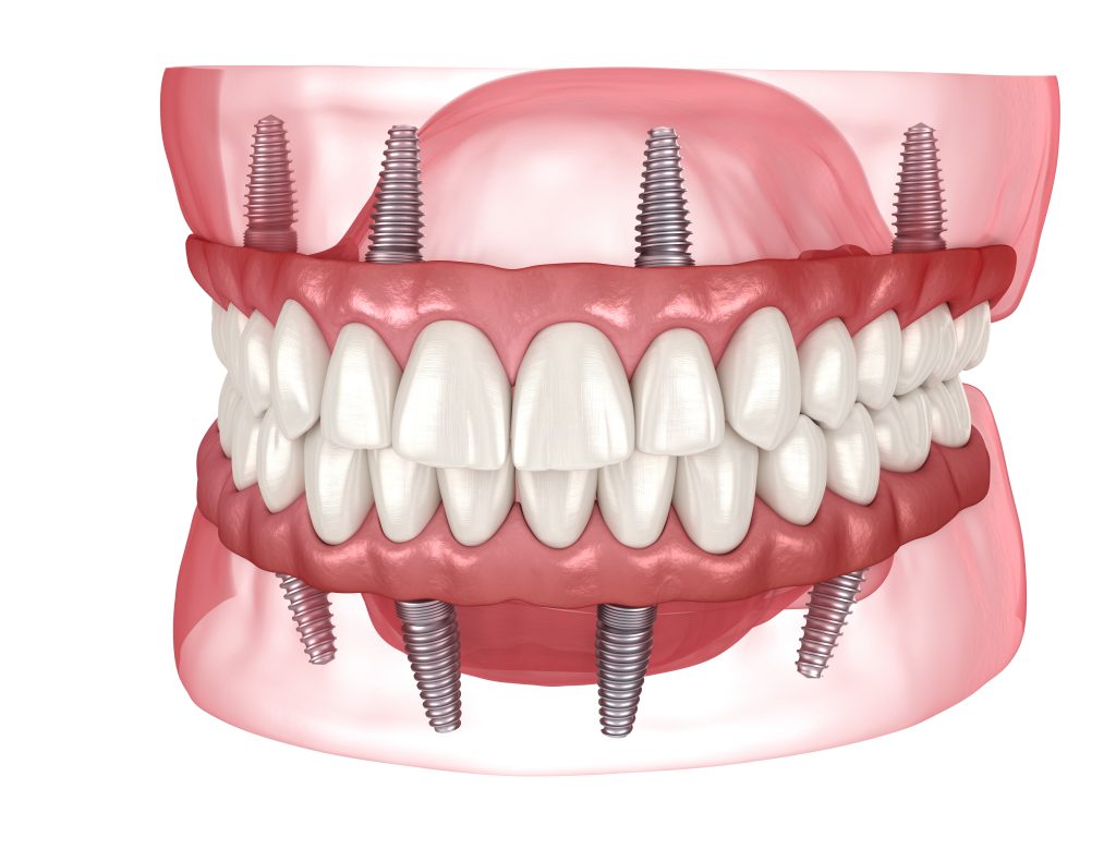 Thailand for All-on-4 Implants