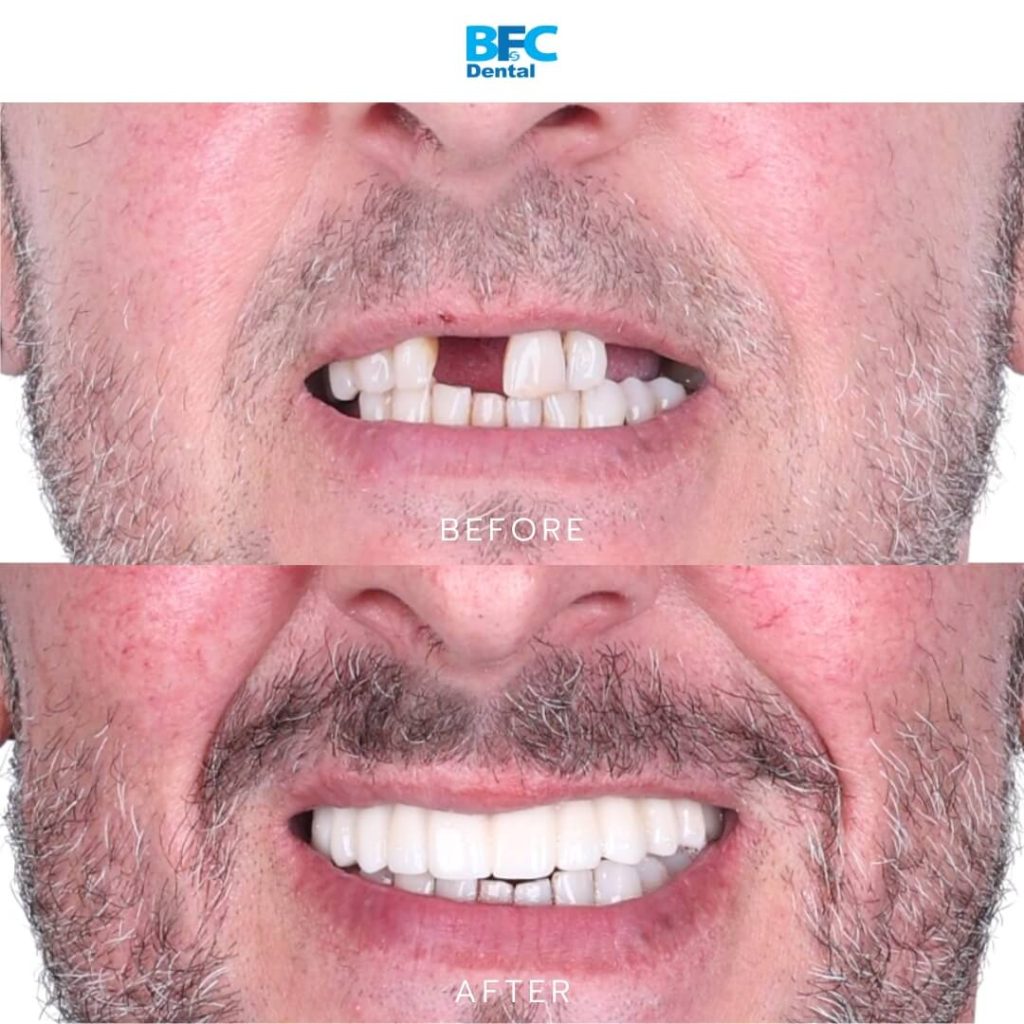 Zirconia Bridge