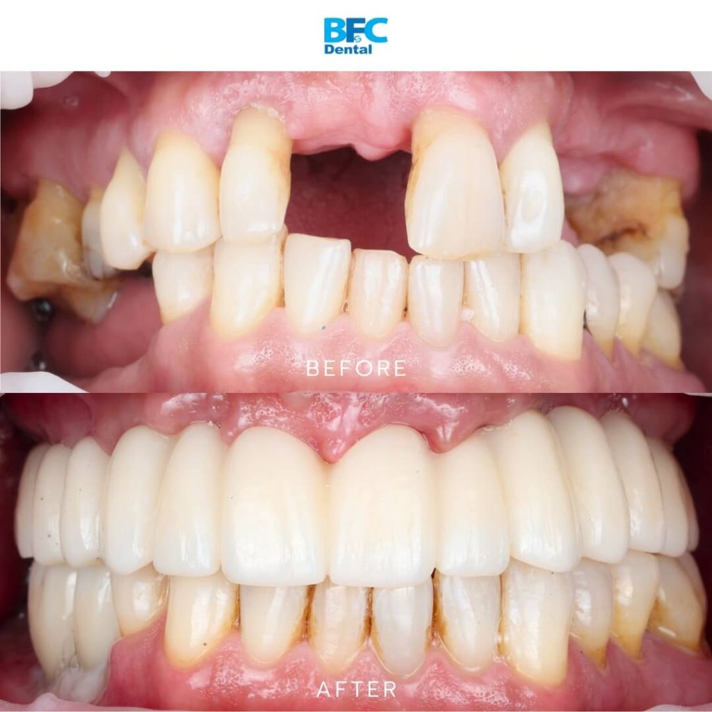 Zirconia Bridge