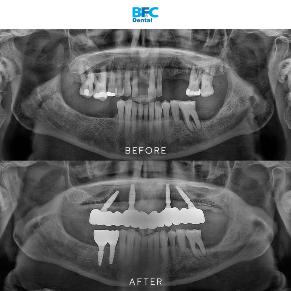 Zirconia Bridge
