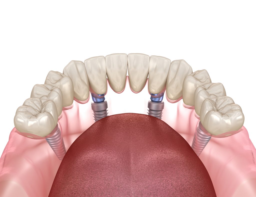All-on-4 Dental Implant Accuracy