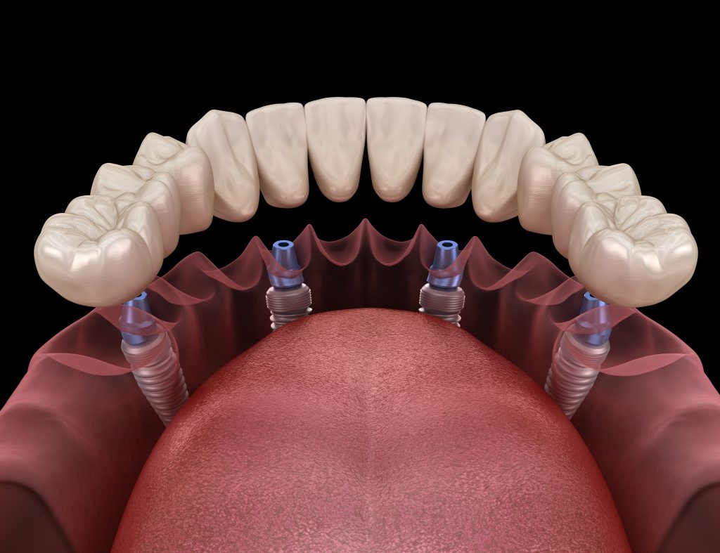 Full Mouth Dental Implants vs Removable Dentures