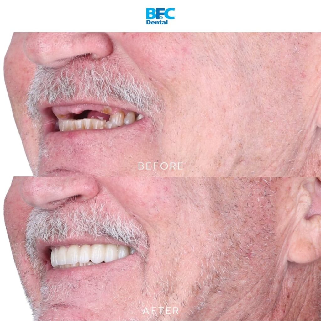 Upper Full Mouth Implants